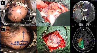 Diffusion tensor imaging, intra-operative neurophysiological monitoring and small craniotomy: Results in a consecutive series of 103 gliomas